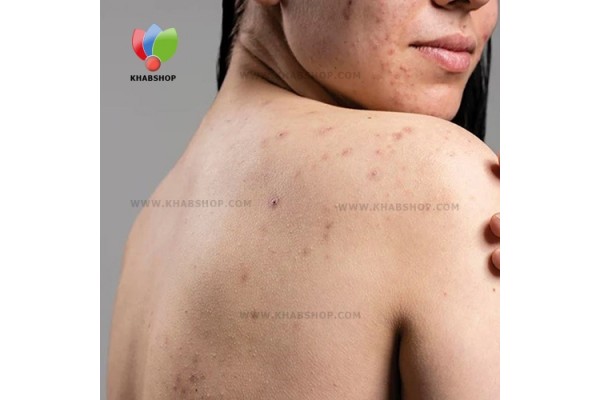 تاثیر تشک آلوده بر بیماری های پوستی